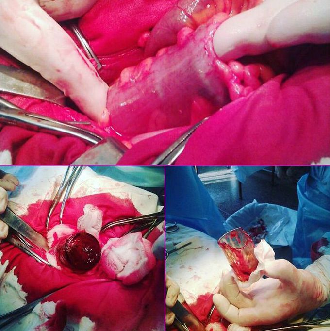 Broken glass in the recto-sigmoid colon! 🍻