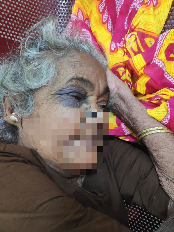Occulo Bullous pemphigoid