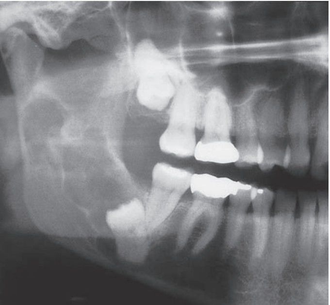 Calcifying epithelial odontogenic tumor