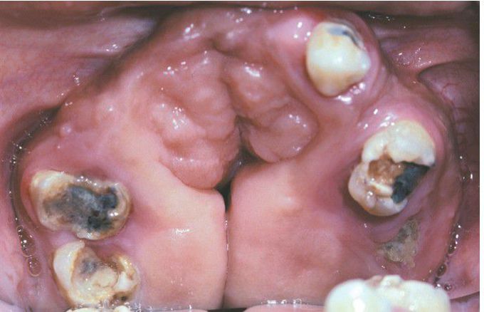 Apert syndrome