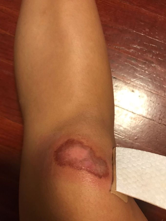 Abrasion