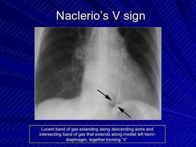 Mediastinal septic shock