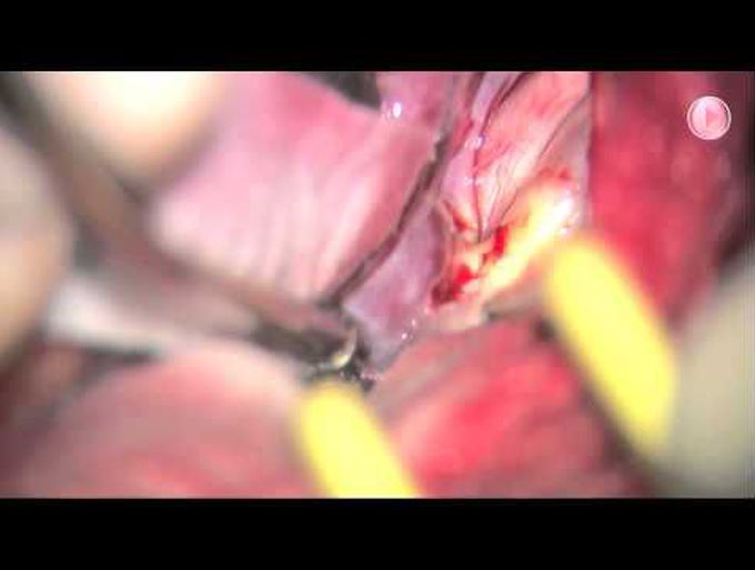 Surgical treatment of a large ruptured internal carotid artery bifurcation aneurysm