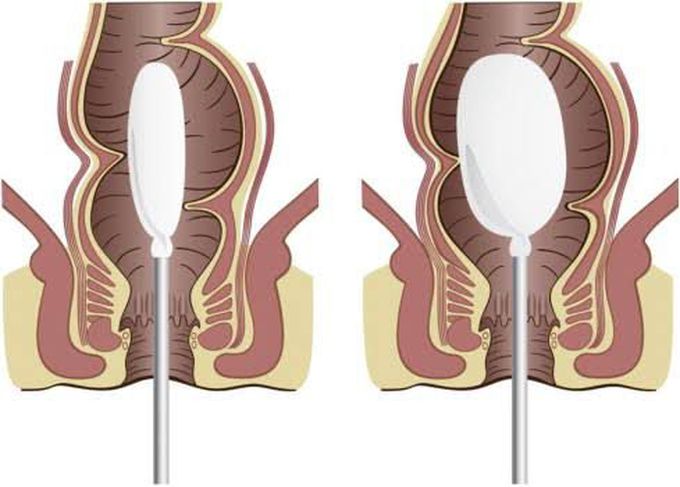 Rectal manometry