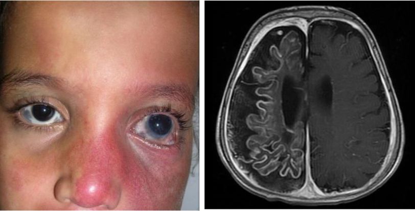 leptomeningeal angiomas