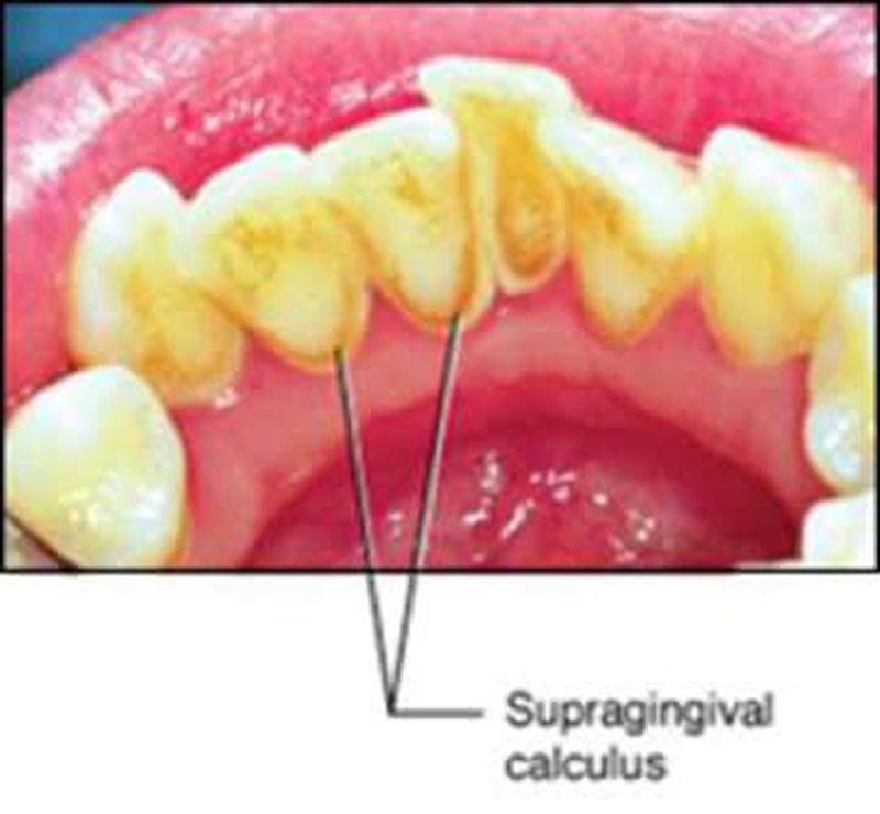Subgingival Calculus And Supragingival Calculus