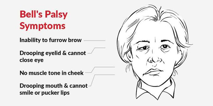 Bell's  palsy Symptoms