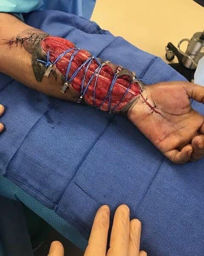 Acute compartment syndrome of the forearm! 