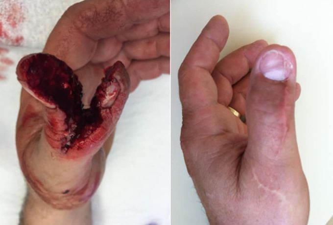 Table saw accident