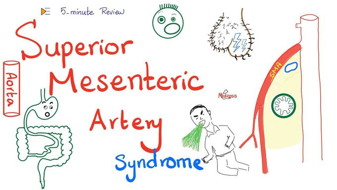 Superior Mesenteric Artery syndrome