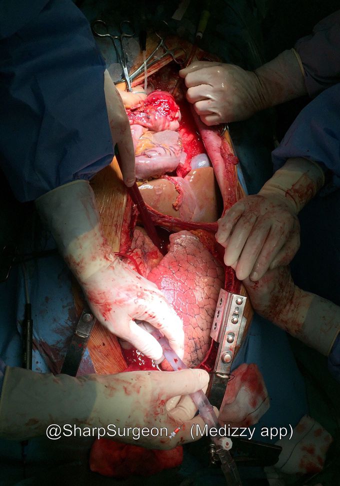 Harvesting organs (kidneys, lungs, liver and corneas) from cadaveric donor... Respect for donation..
