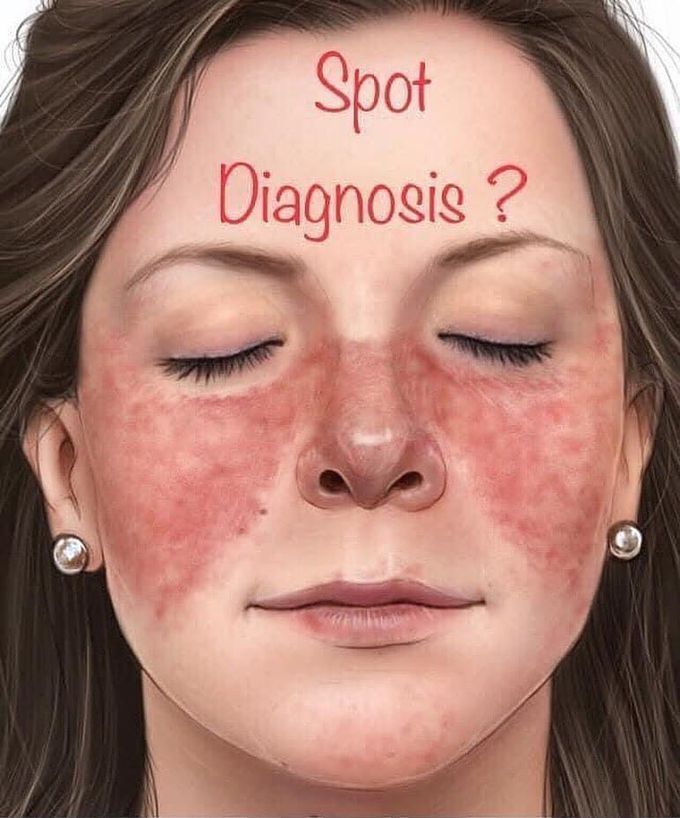BUTTERFLY RASH- systemic lupus erythematosus
