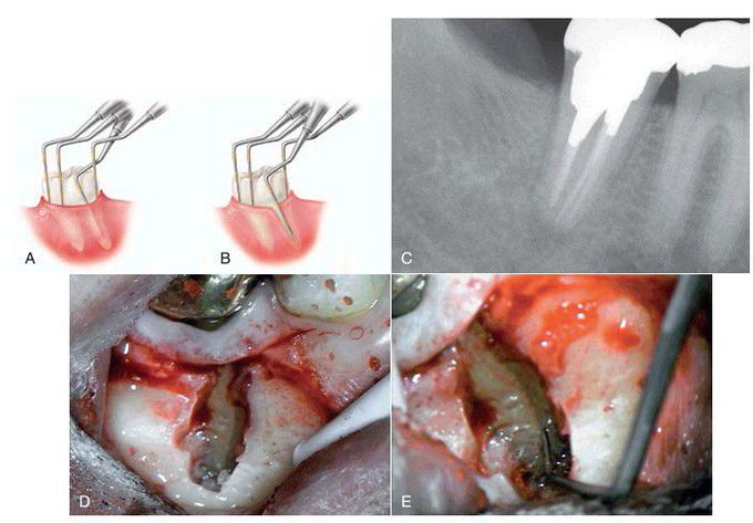 Narrow periodontal defect