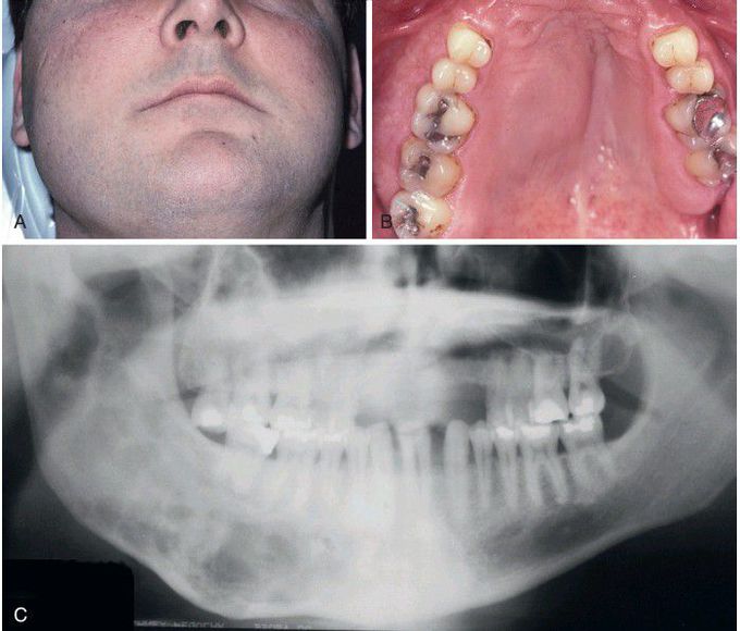 Polyostotic Fibrous Dysplasia