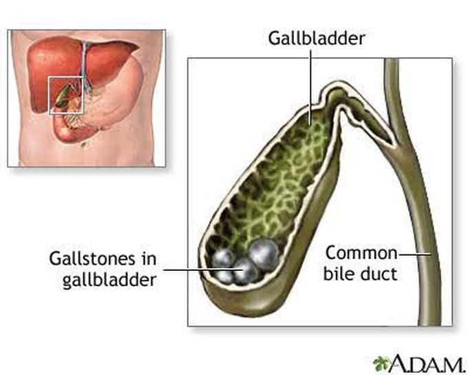 Cholelithiasis treatment