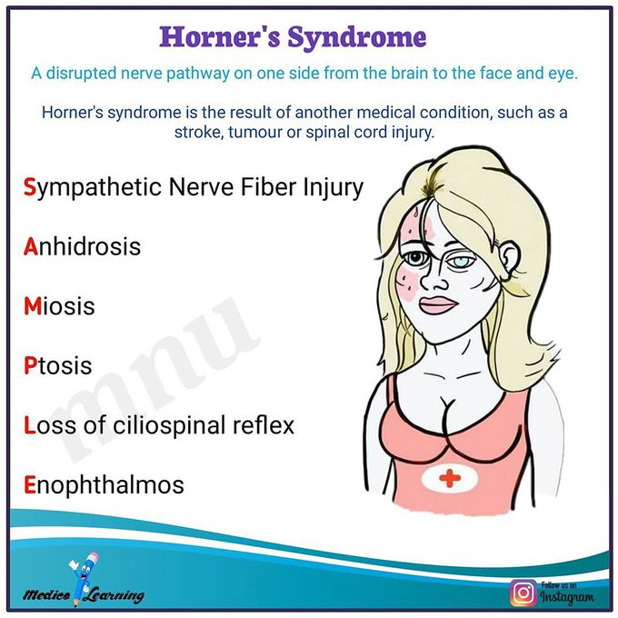 Horners Syndrome