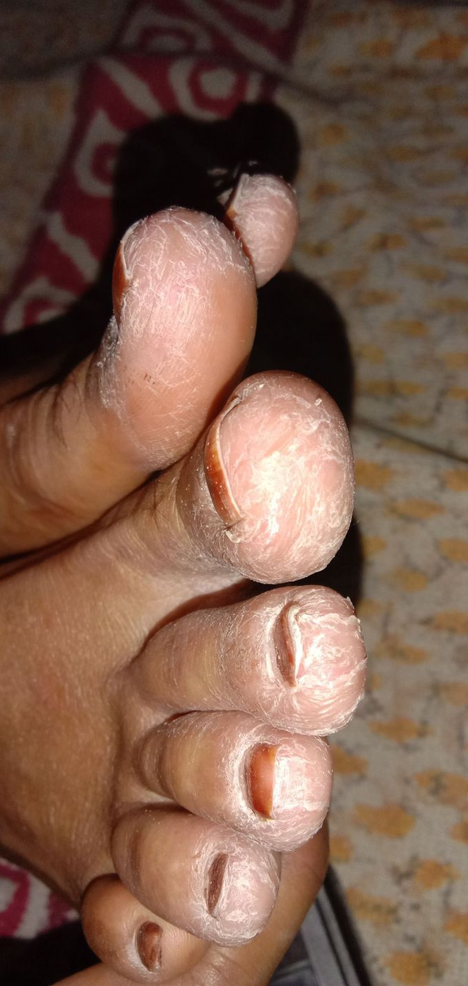 Disease name?