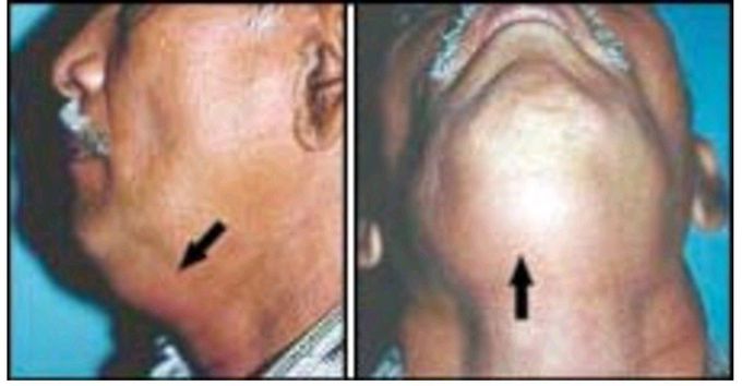 Submental space infection