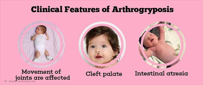 Arthrogryposis symptoms