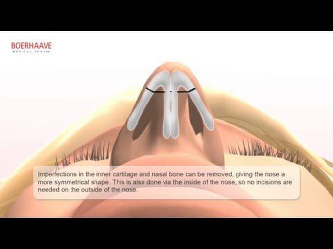 Nose Correction - Animation