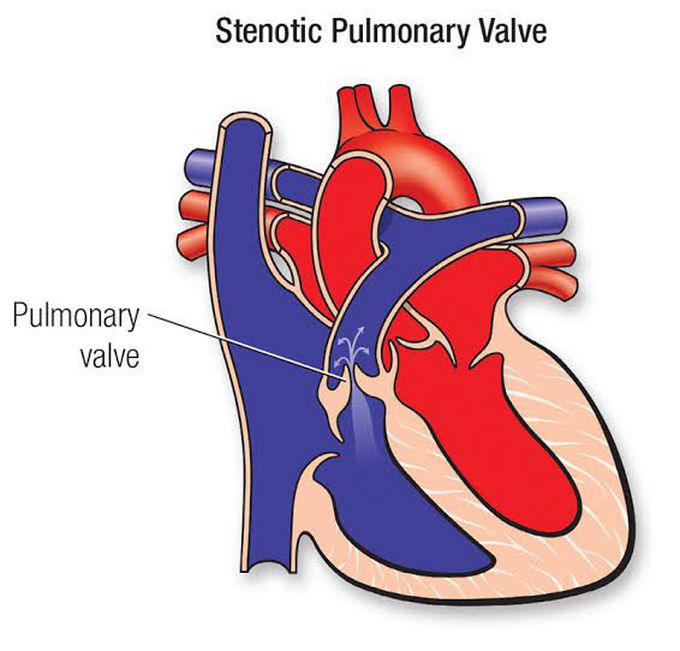 Causes of pulmonary stenosis