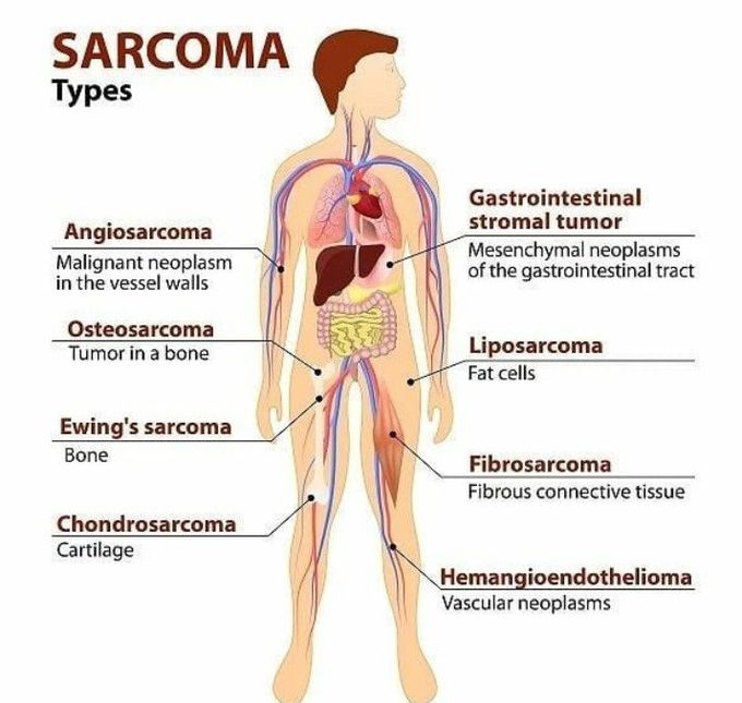 Types of sarcoma