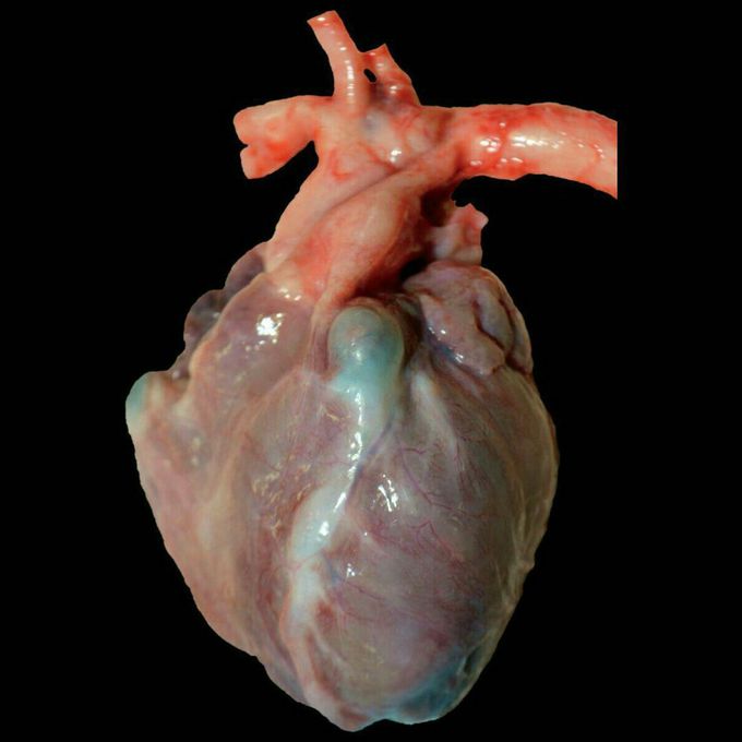 Enlarged heart with giant coronary artery aneurysms of the right coronary and left anterior descending arteries in Kawasaki disease
.#dr.vijay sharma