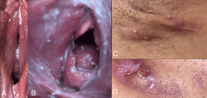 Symptoms of Vulvovaginitis