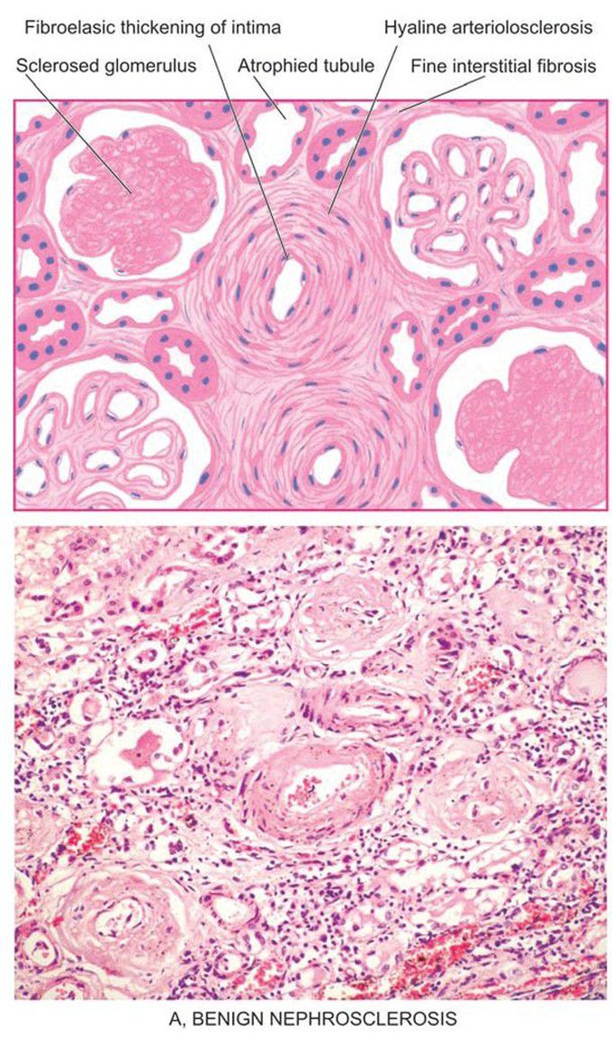 Microscopic changes in kidney in hypertension