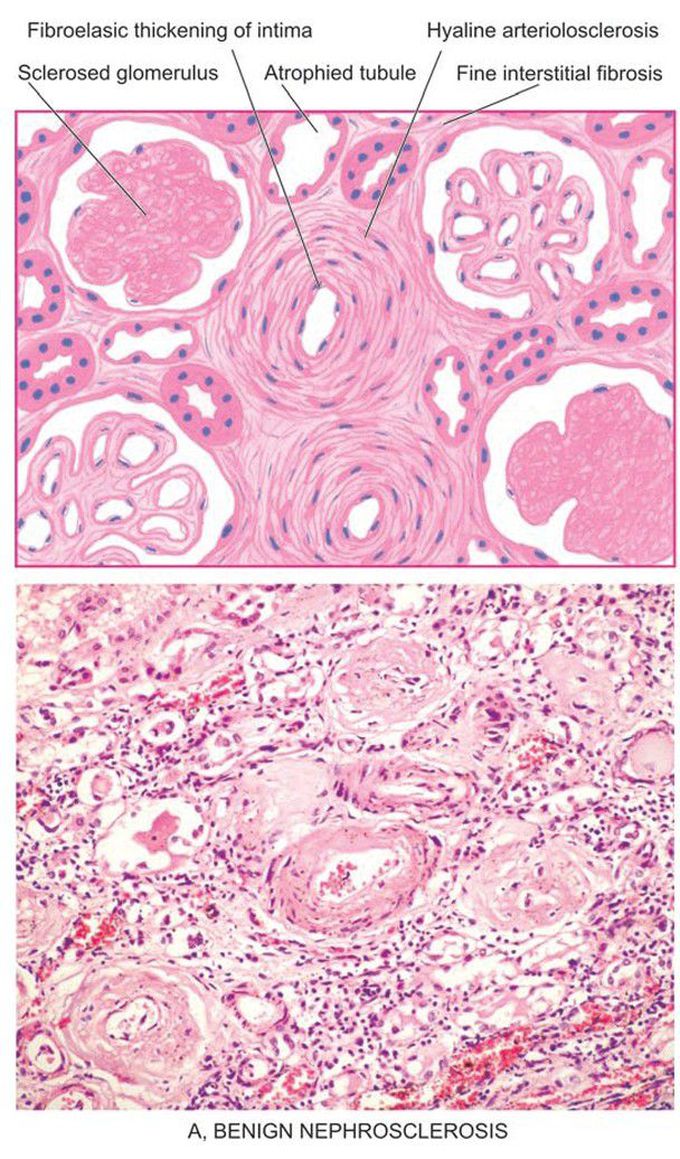 Microscopic changes in kidney in hypertension