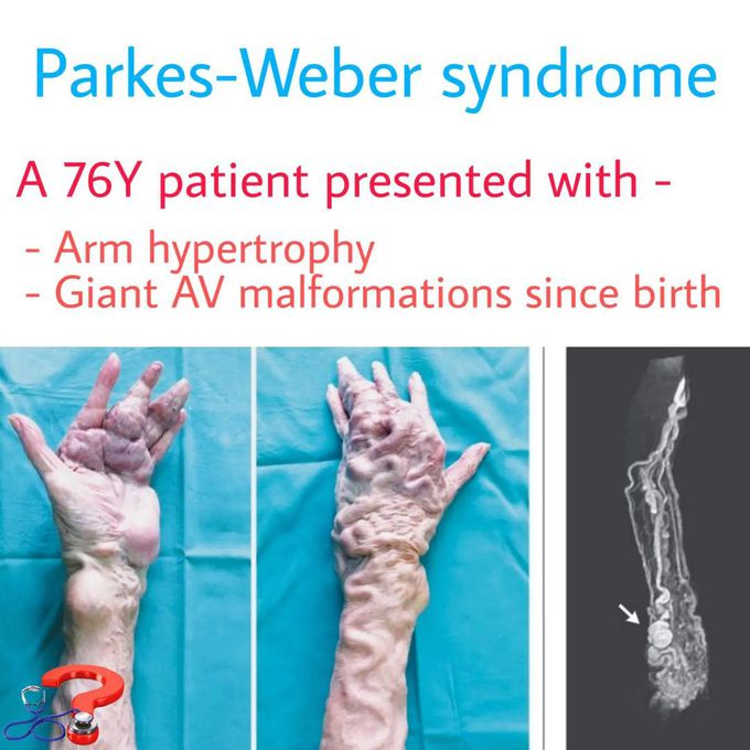Parkes-Weber Syndrome
