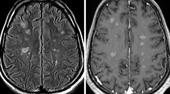 Treatment of neurosarcoidosis