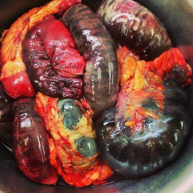 GANGRENOUS BOWEL