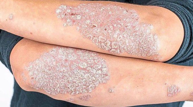 Psoriasis