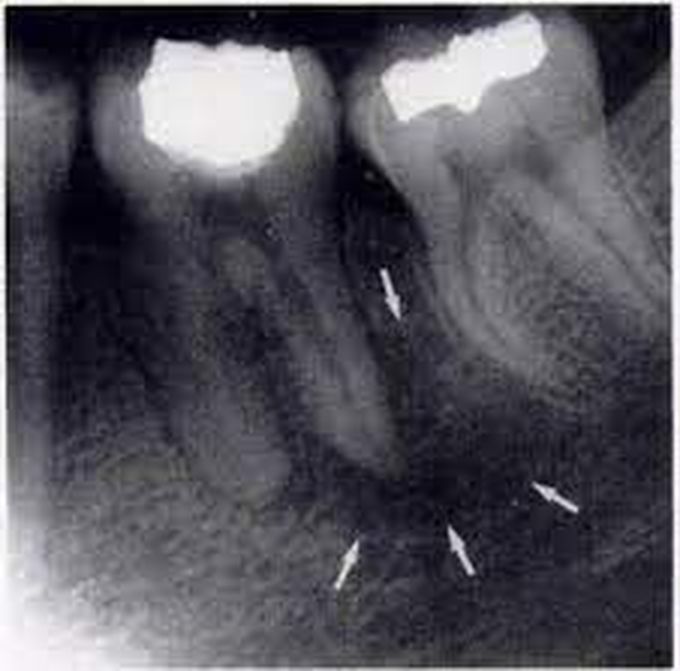 What causes a periapical abscess? - MEDizzy