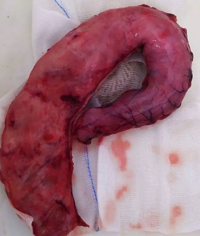 Sleeve gastrectomy