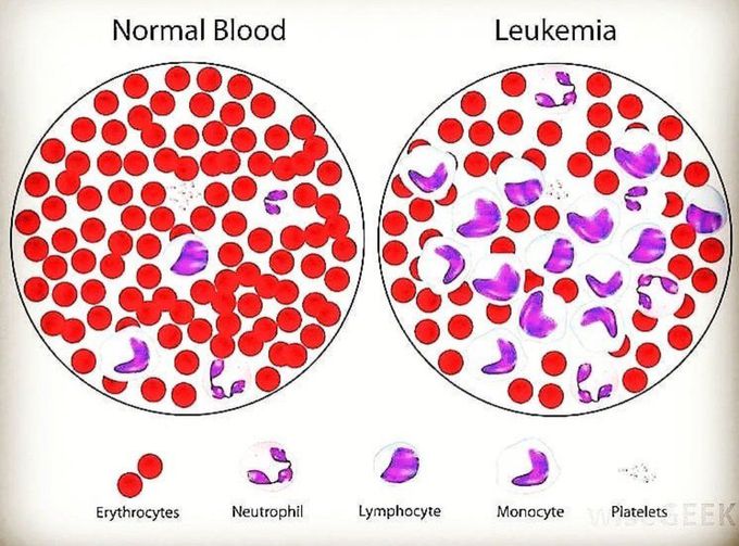 Normal Blood Vs Leukemia