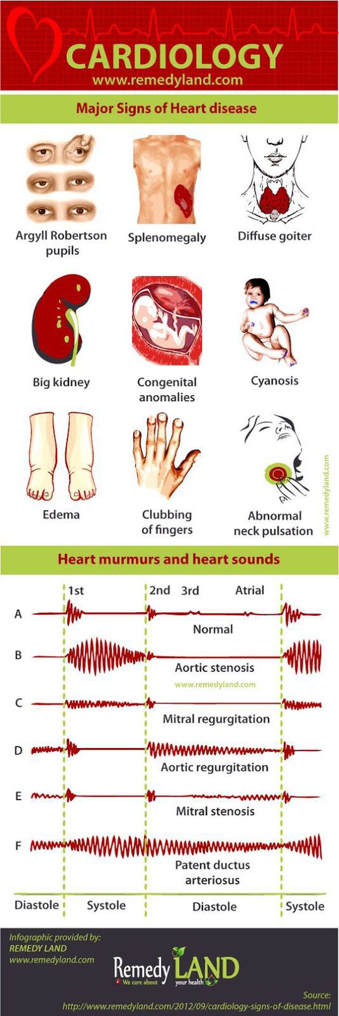 Cardiology: signs of heart disease, heart murmurs and heart sounds