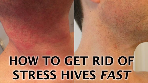 Hives Treatment How To Get Of A Stress Rash - MEDizzy