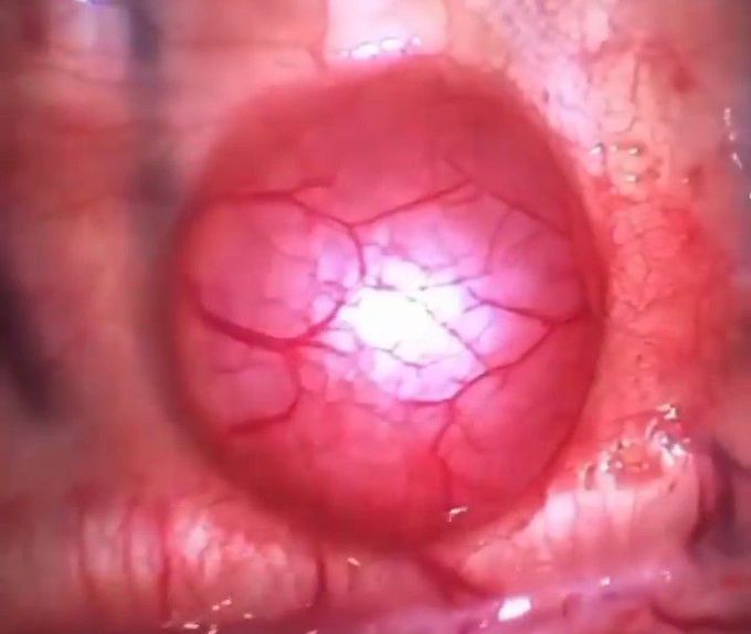 Bronchial tumor in newborn