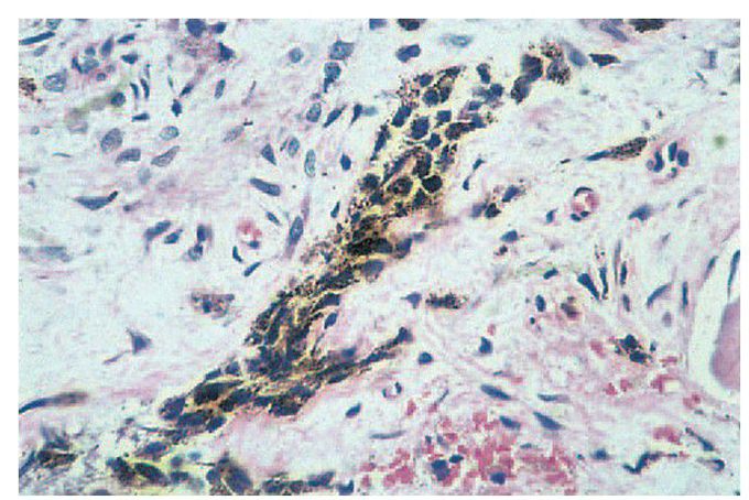Melanotic neuroectodermal tumour of infancy.