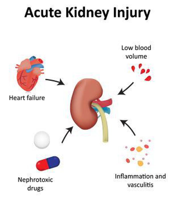 Acute kidney injury (AKI)
