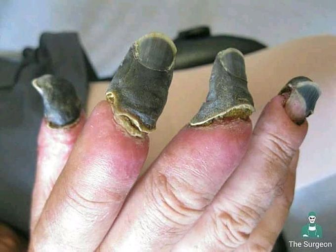 Finger gangrene