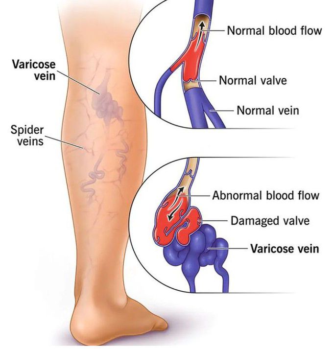 Varicose Veins