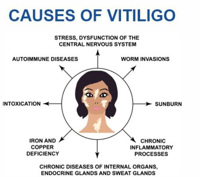 Cause of Vitiligo