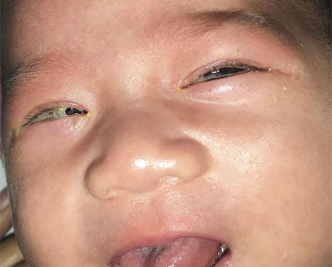 A Newborn with Sticky Eyes!