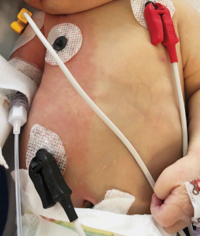 Harlequin Color Change in a Neonate