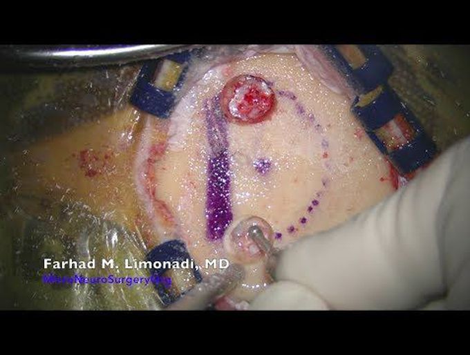 Brain Tumor: Surgical removal of a growing brain tumor (meningioma)
