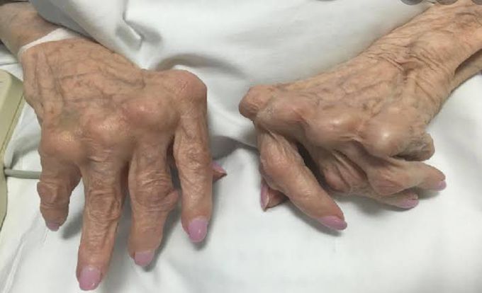 causes of rheumatoid arthritis