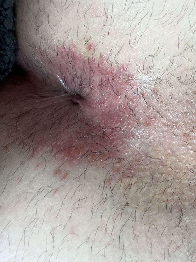 Anal rash and itching